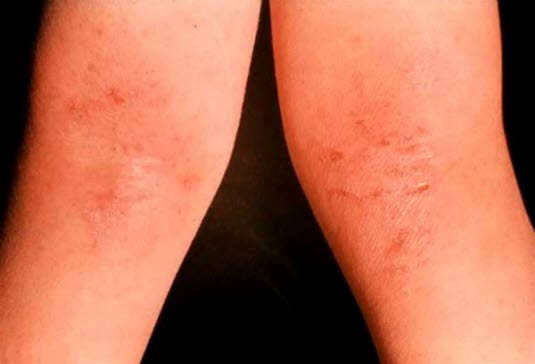 Atopisk eksem i knehasene