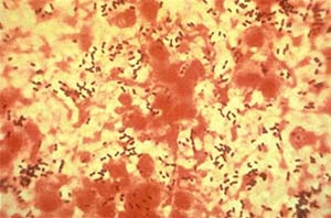 Pneumokokker Pneumokokker