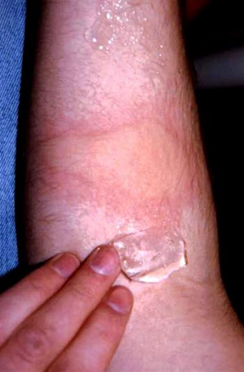 Positiv test på kuldeurticaria: rubor, kvaddel (urticae) og sterkt kløe etter noen minutter med isbit mot huden.