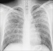 Sarkoidose i lungene