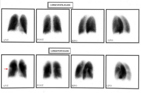 Lungeemboli, perfusjons scintigrafi