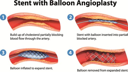 Angioplastikk og stenting Angioplastikk og stenting