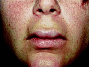 Angioødem i ansiktet og leppene med tydelig opphovning.