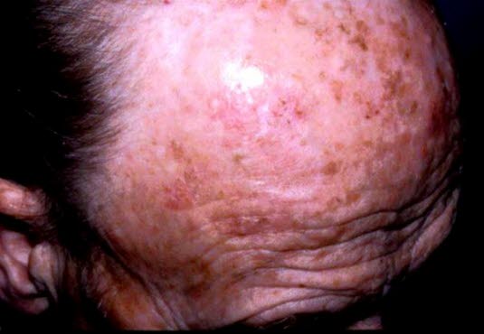 Kronisk soleksponering mot skallet hodebunn med solskade og atrofi, teleangiektasier og rynker. Multiple aktiniske keratoser i form av rødbrune flekker med lett flassende og hyperkeratotisk overflate