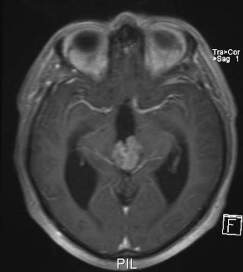 pineocytom 2 pineocytom 2