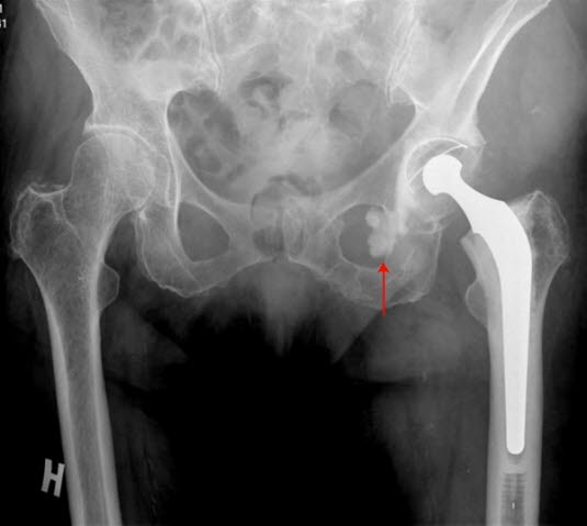 Kunstig hofteledd, skiftet både leddhode og leddskål.