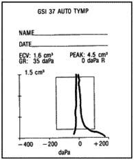 Tympanogram, ossikulær disartikulaskon