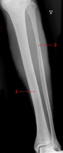 Normalt røntgenbilde av leggen Normalt røntgenbilde av leggen