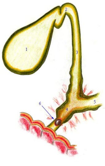 Galleblære - stein distalt i choledochus