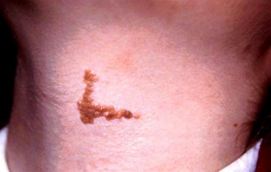 Velavgrenset, verrucøs, pigmentert fortykkelse av epidermis. Medfødte epidermale nævus er en differensialdiagnose til kongenitt melanocytt-nævus.