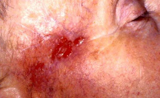 Dårlig avgrenset, arraktig tumor av såkalt morfeatype.