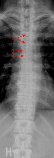 Toracalcolumna, front Toracalcolumna, front
