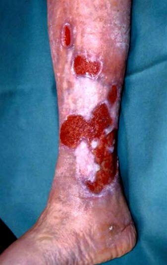 Velavgrensede sår som er optimalt stelt med curretage før hudtransplantasjon.