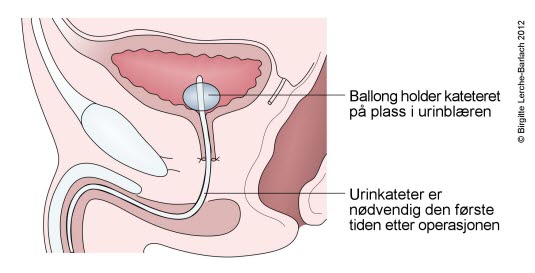 Fjernet prostata (resultat etter radikal prostatektomi) Fjernet prostata (resultat etter radikal prostatektomi)