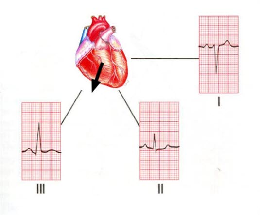 Høyre aksedeviasjon Høyre aksedeviasjon