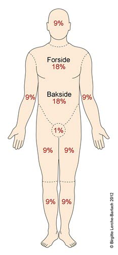Ni prosentregel ved brannskader Ni prosentregel ved brannskader