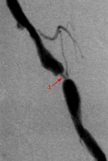 Forsnevring i arterie Forsnevring i arterie