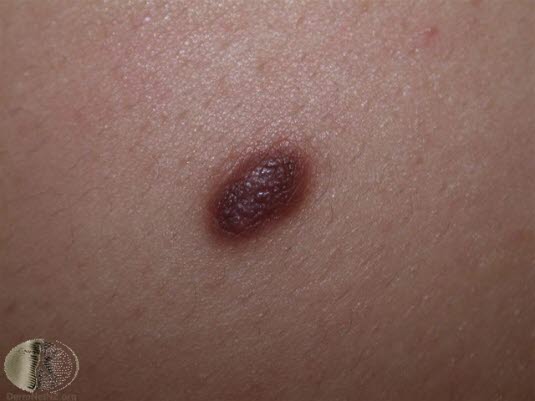 Dermatofibrom, pigmentert