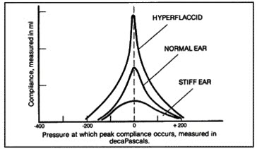Tympanometri, bevegelighetsmønstre Tympanometri, bevegelighetsmønstre