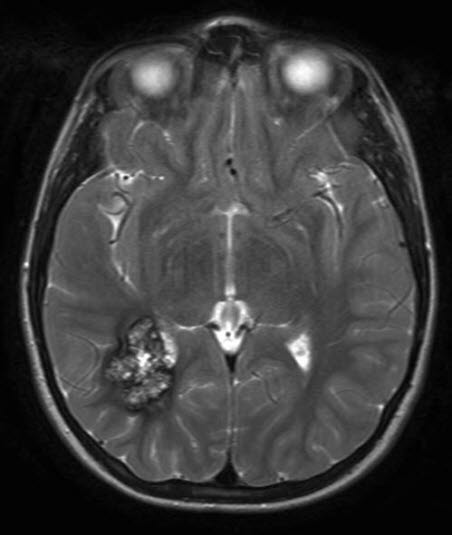 kavernøst hemangiom 2 kavernøst hemangiom 2
