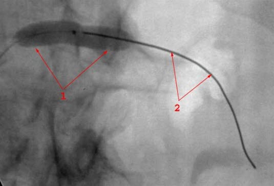 Nyrearteriestenose dilatasjon
