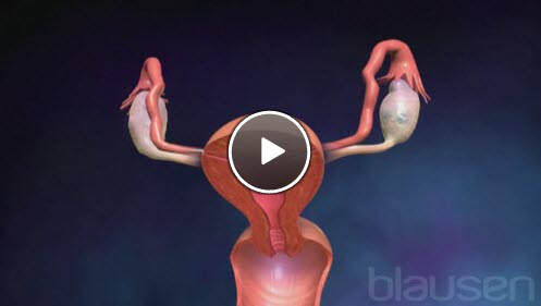 eggstokkreft eggstokkreft