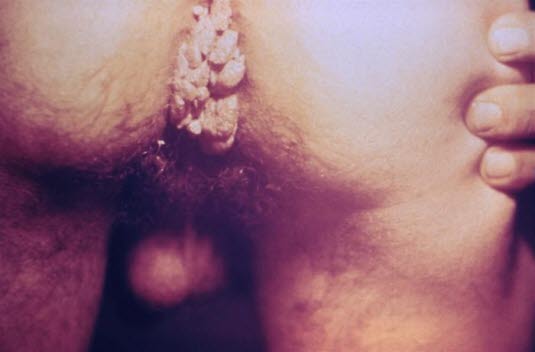 Kjønnsvorter. Foto: PHIL, CDC.