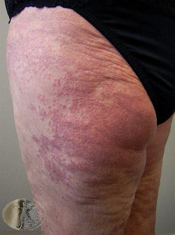 Granuloma annulare, utbredt