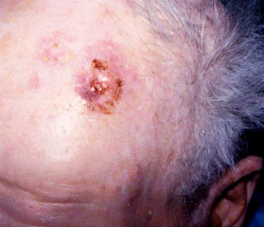 Solskadet hud med rasktvoksende, ulcererende tumor.