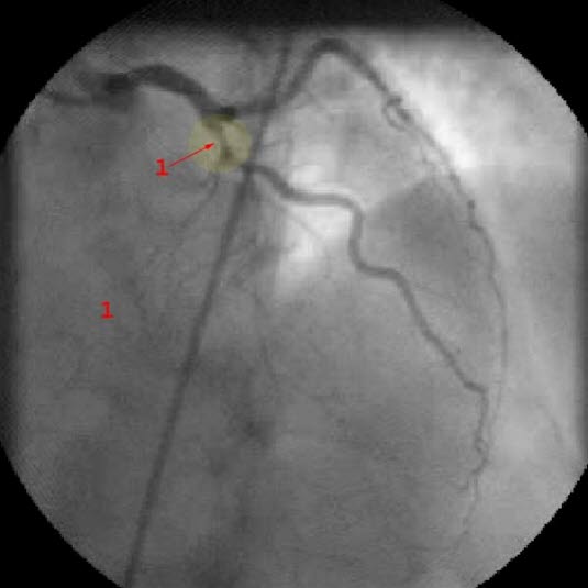 LAD-stenose, angiografi LAD-stenose, angiografi