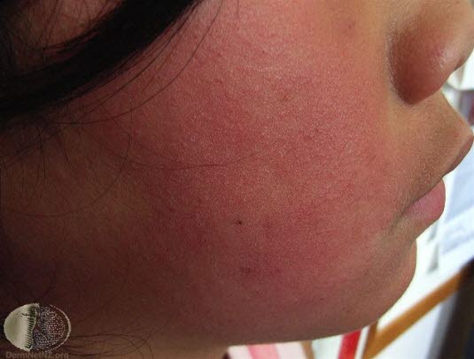 Femte barnesykdom, kinn 1