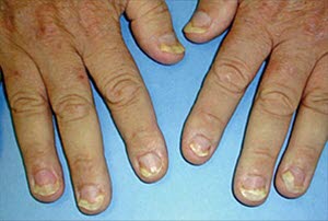Neglepsoriasis