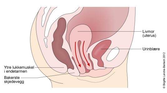 Nedsunken livmor Nedsunken livmor