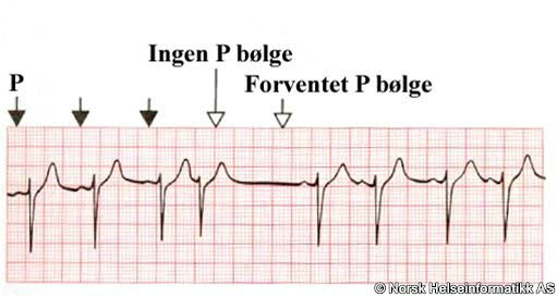 Supraventrikulær ekstrasystole