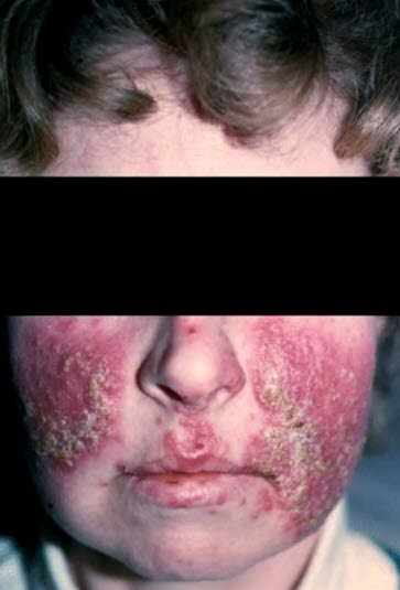 Rosacea, uttalt.