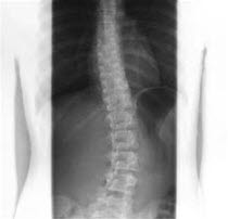 Skoliose, røntgen