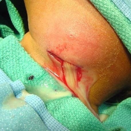 Abscess som tømmes for puss