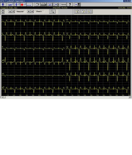 Ventrikulær bigemini Ventrikulær bigemini