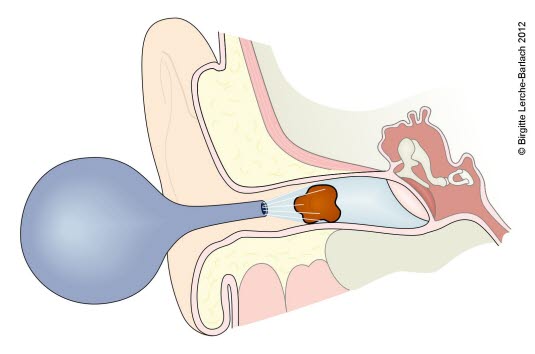 Øreskylling Øreskylling