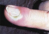 Paronykion Paronykion