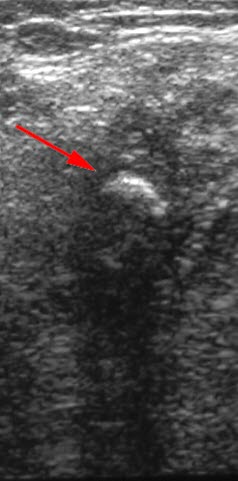 Sialoadenitt, konkrement (UL)