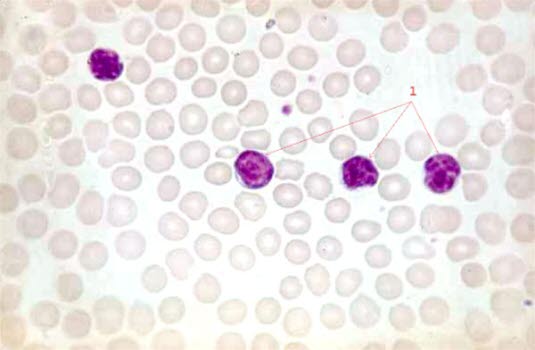 Kronisk lymfatisk leukemi (x 40)