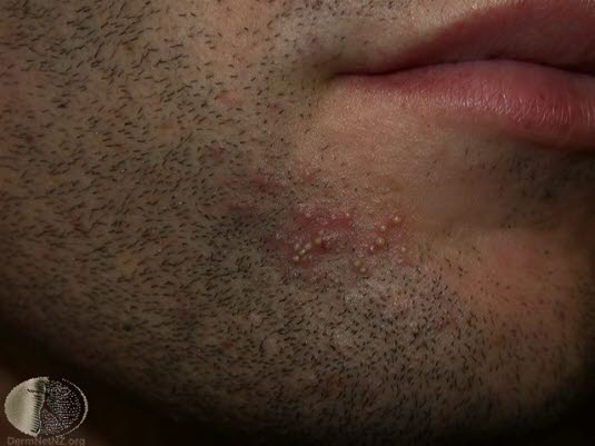 Follikkulitt etter barbering