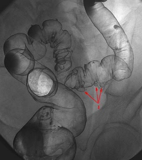 Colondivertikler Colondivertikler