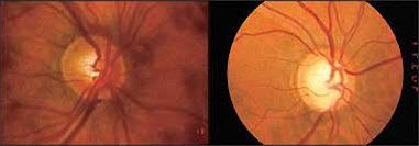 Glaukomatøs papille Glaukomatøs papille