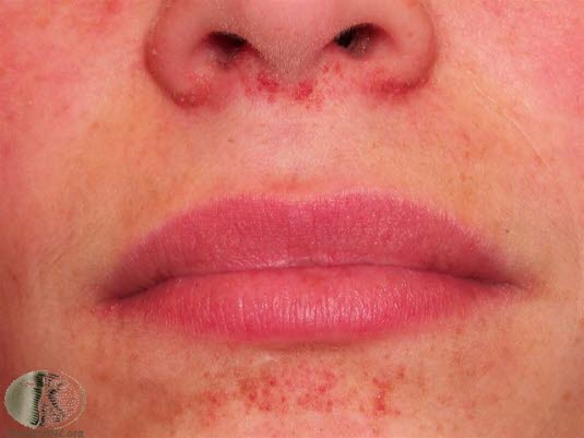 Tuberøs sklerose, angiofibrom tidlig fase