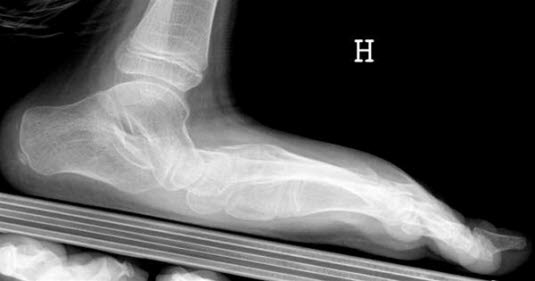 Uttalt plattfotdeformitet Uttalt plattfotdeformitet