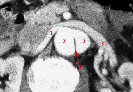 Aortadisseksjon (CT axial) Aortadisseksjon (CT axial)