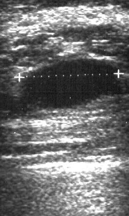 Ultralyd mamma, cyste