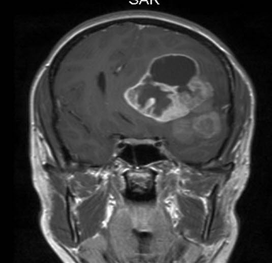 anaplastisk ependymom 2 anaplastisk ependymom 2